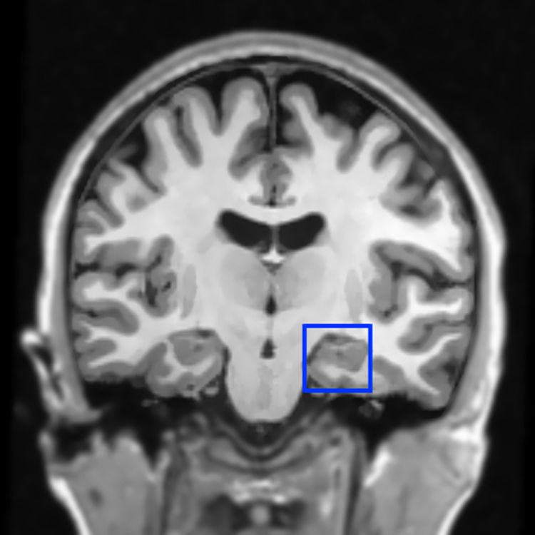 The right hippocampus (pictured in the blue box) was one of the brain regions that showed significant changes in activity after fear memory reactivation during sleep. PHOTO COURTESY OF KATHERINA HAUNER.