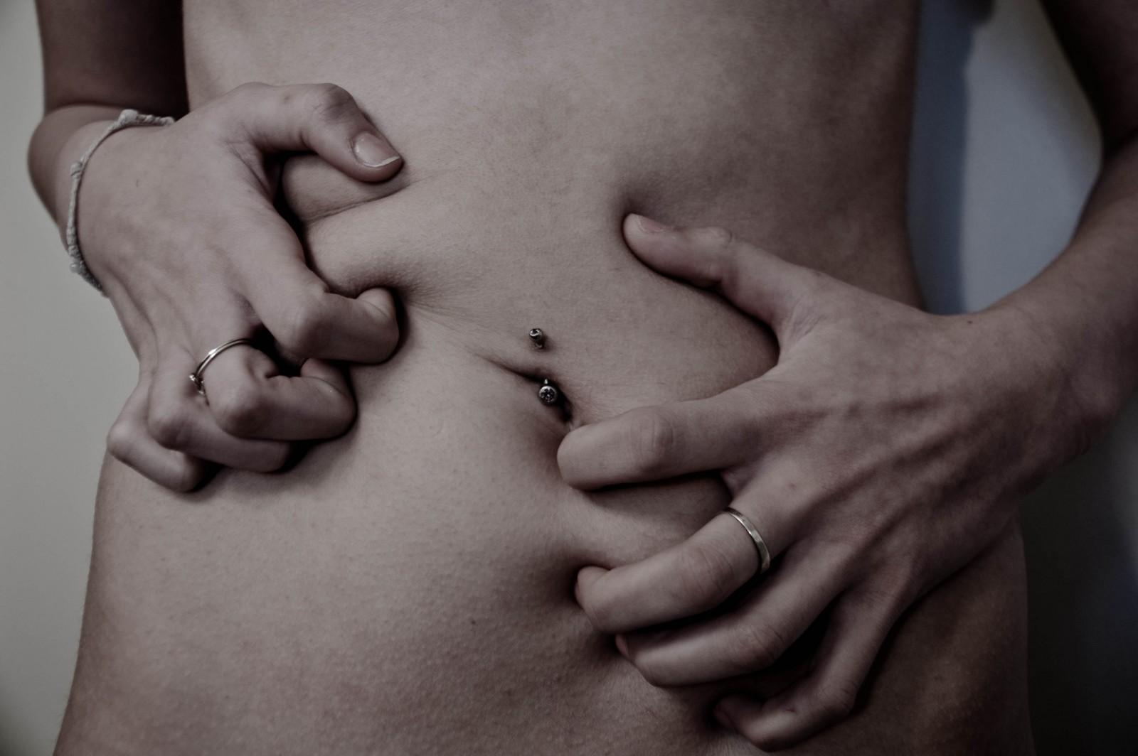 EDITORIAL: For-profit eating disorder treatment centers take advantage of wealthy, ignore poor