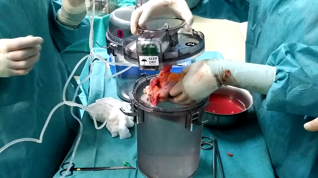 A donor heart being secured for preservation in a suspension device to keep the heart in stasis during its travel time between the donor and transplant recipient. COURTESY OF PARAGONIX TECHNOLOGIES